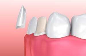 Dental Veneers: Porcelain Veneer installation Procedure. 3D illustration